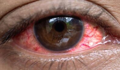 Uganda’da salgın: 7 bin 500 kişide “kırmızı göz” hastalığı görüldü