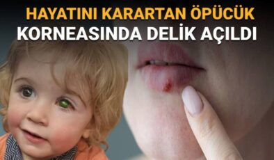 2 yaşındaki bir çocuk öpücük yüzünden kör oldu: Herpes Simpleks Virüsü (HSV) nedir, belirtileri neler?