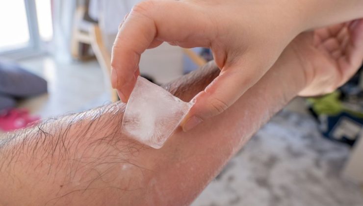 Yanıklara buz koyuyor musunuz? Bu tehlikesi çok az biliniyor