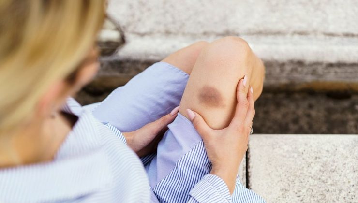 Vücuttaki açıklanamayan morluklar neyin belirtisi? Ölümcül hastalığın habercisi olabilir