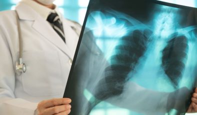 Sigara içmeyenlerde neden Akciğer kanseri görülüyor: 5 nedeni var