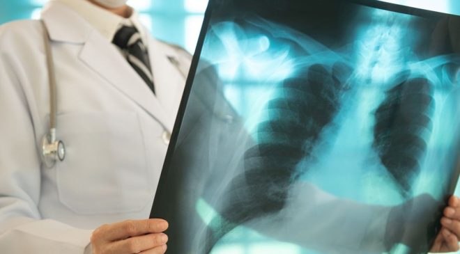 Sigara içmeyenlerde neden Akciğer kanseri görülüyor: 5 nedeni var
