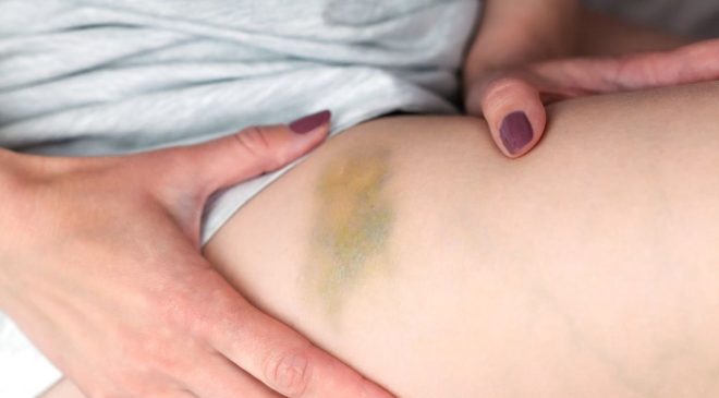 Vücudundaki morlukları önemsemedi: Meğer kanserin ilk belirtisiymiş