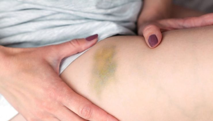 Vücudundaki morlukları önemsemedi: Meğer kanserin ilk belirtisiymiş