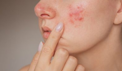 Harvardlı uzman açıkladı: Karaciğer hastalığının 5 cilt belirtisi