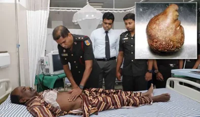 Sri Lanka’da Rekor Büyüklükte Mesane Taşı Çıkarıldı