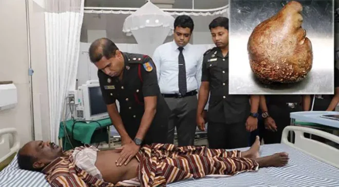 Sri Lanka’da Rekor Büyüklükte Mesane Taşı Çıkarıldı