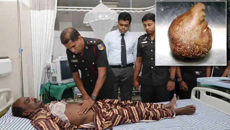 Sri Lanka’da Rekor Büyüklükte Mesane Taşı Çıkarıldı